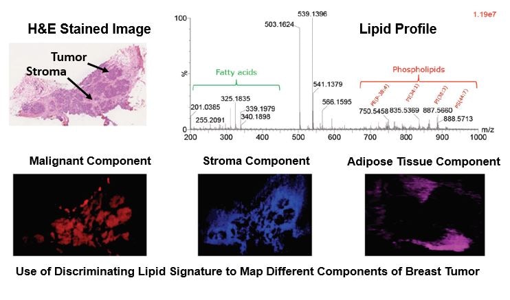 Use of Discriminating Lipid Signature to Map Different Components of Breast Tumor 