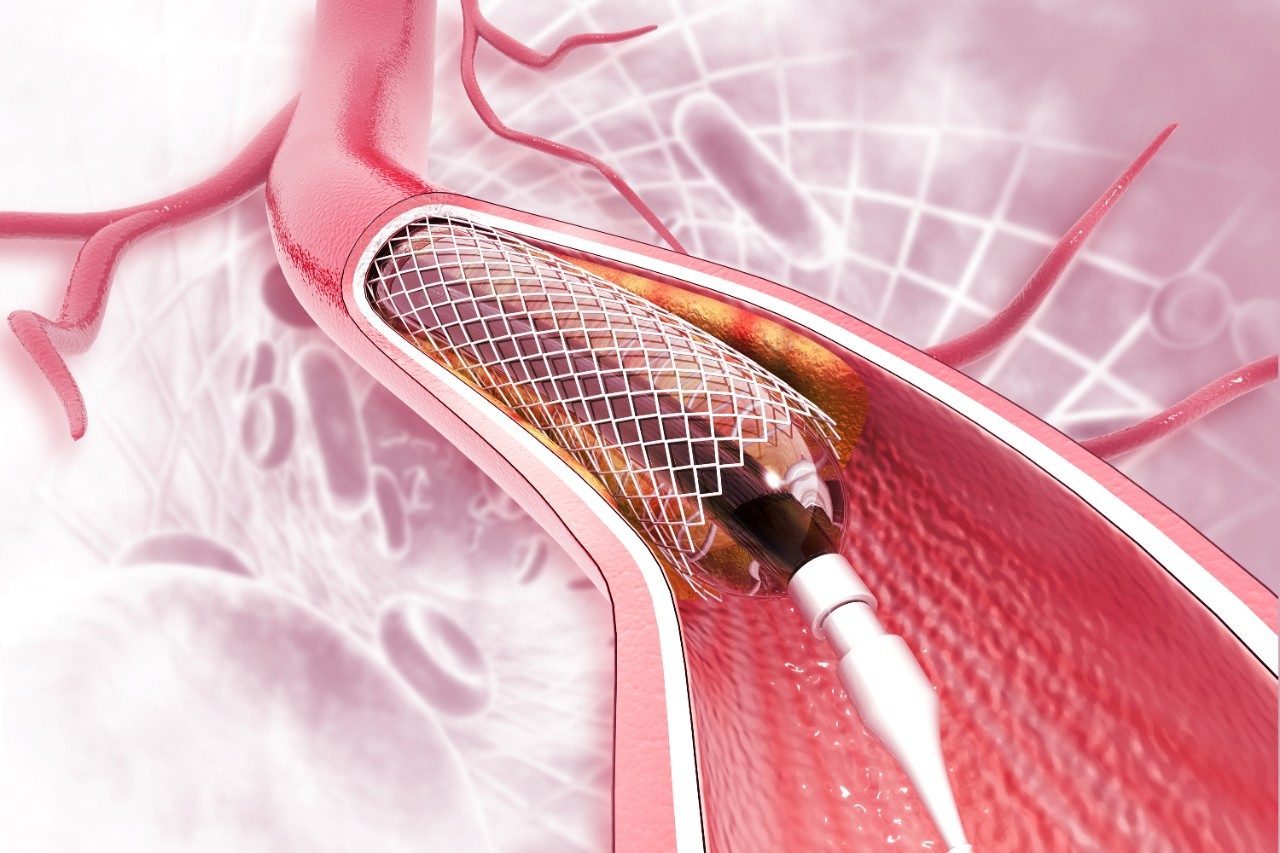 Stent angioplasty in heart vessel