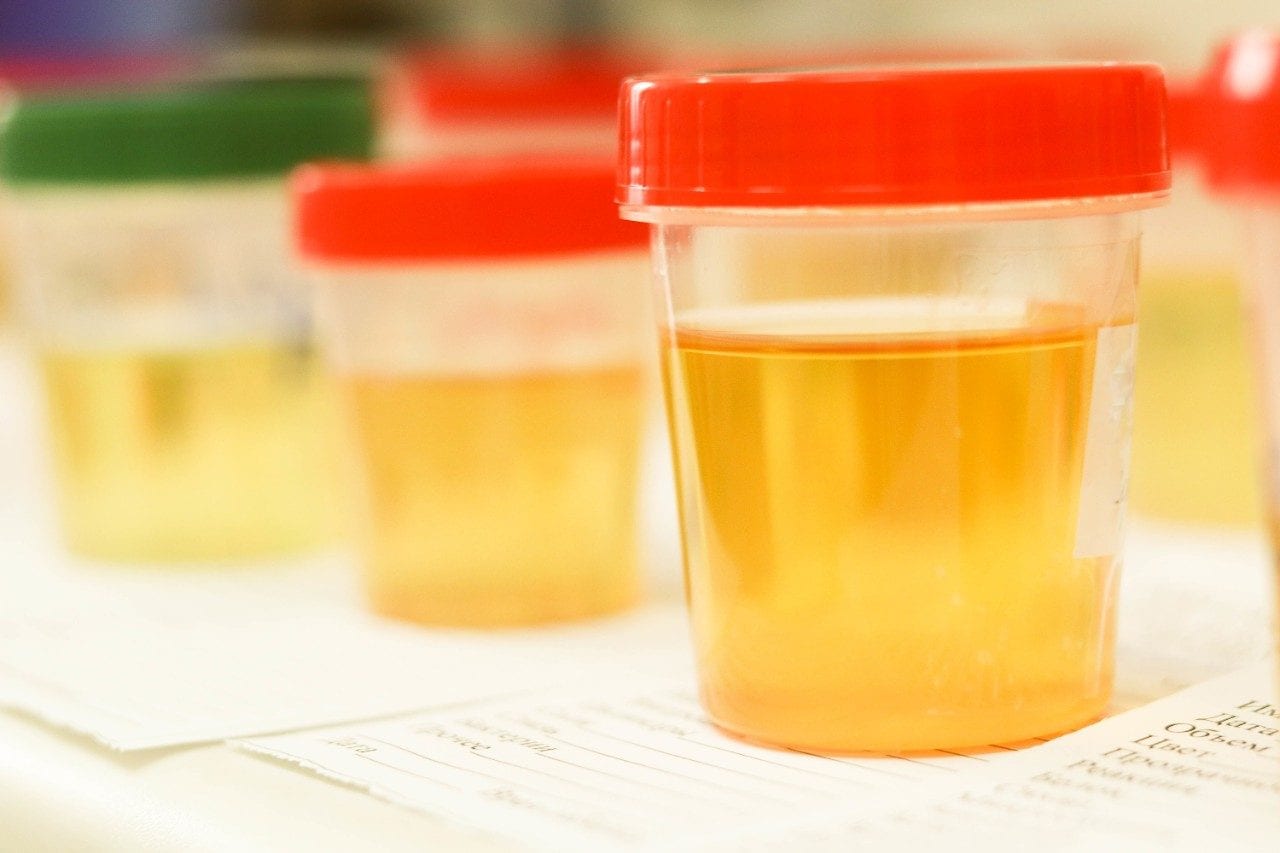 Row of urine sample cups