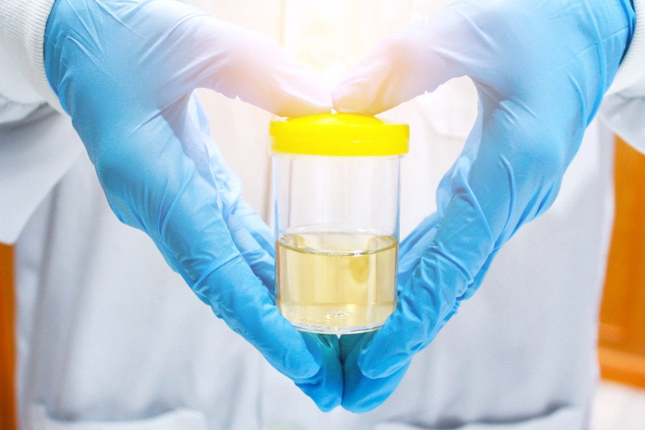 Urine sample in gloved hands